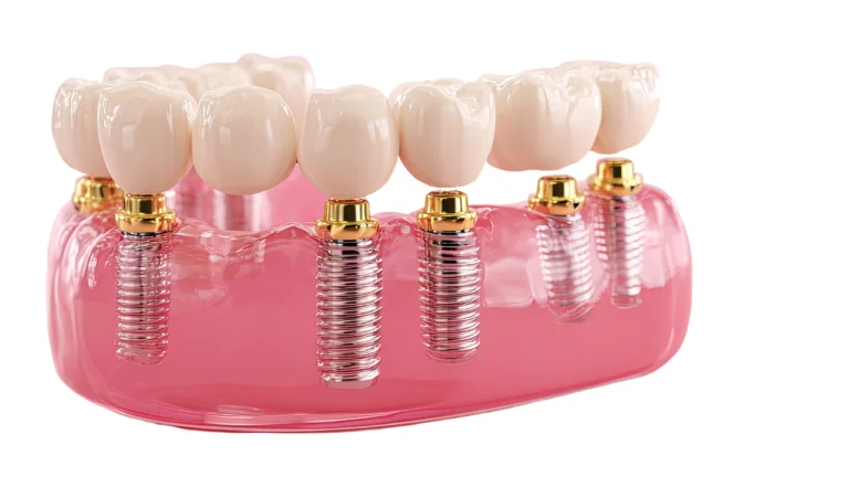 All-on-6: When Six Implants Are the Better Answer